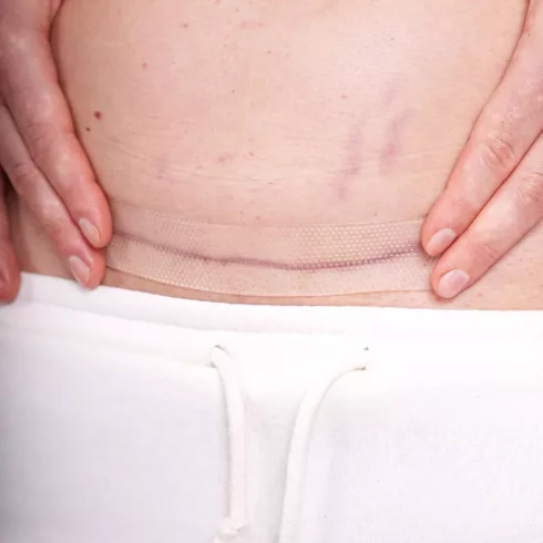 Momcare Császármetszés hegkezelő szilikontapasz 3db S-M